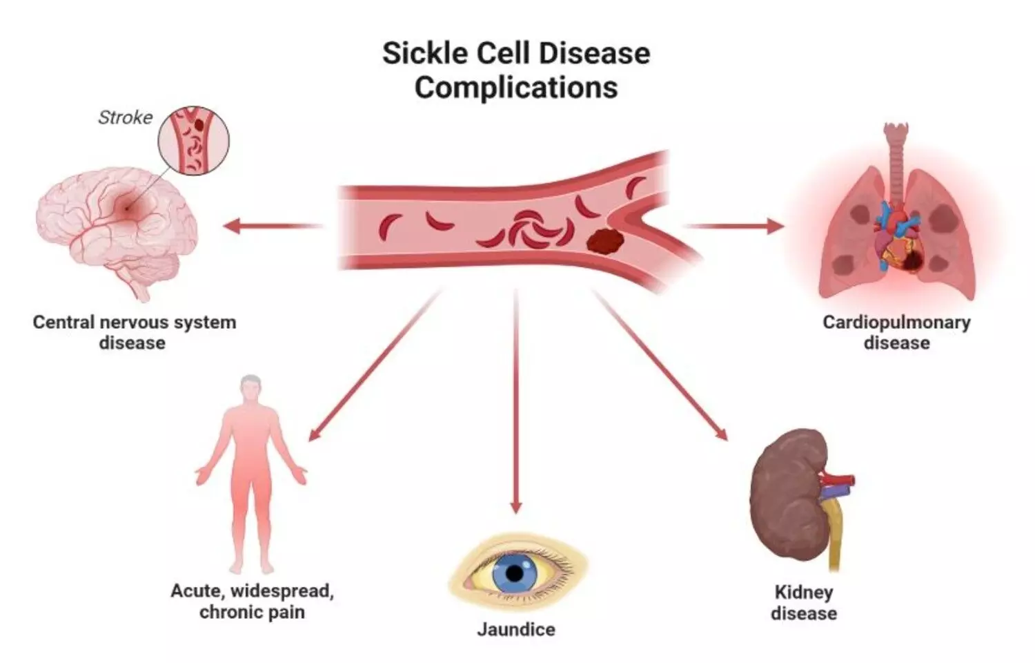 Arginine Therapy fails to Shorten Sickle Cell Pain Crises,  suggests study