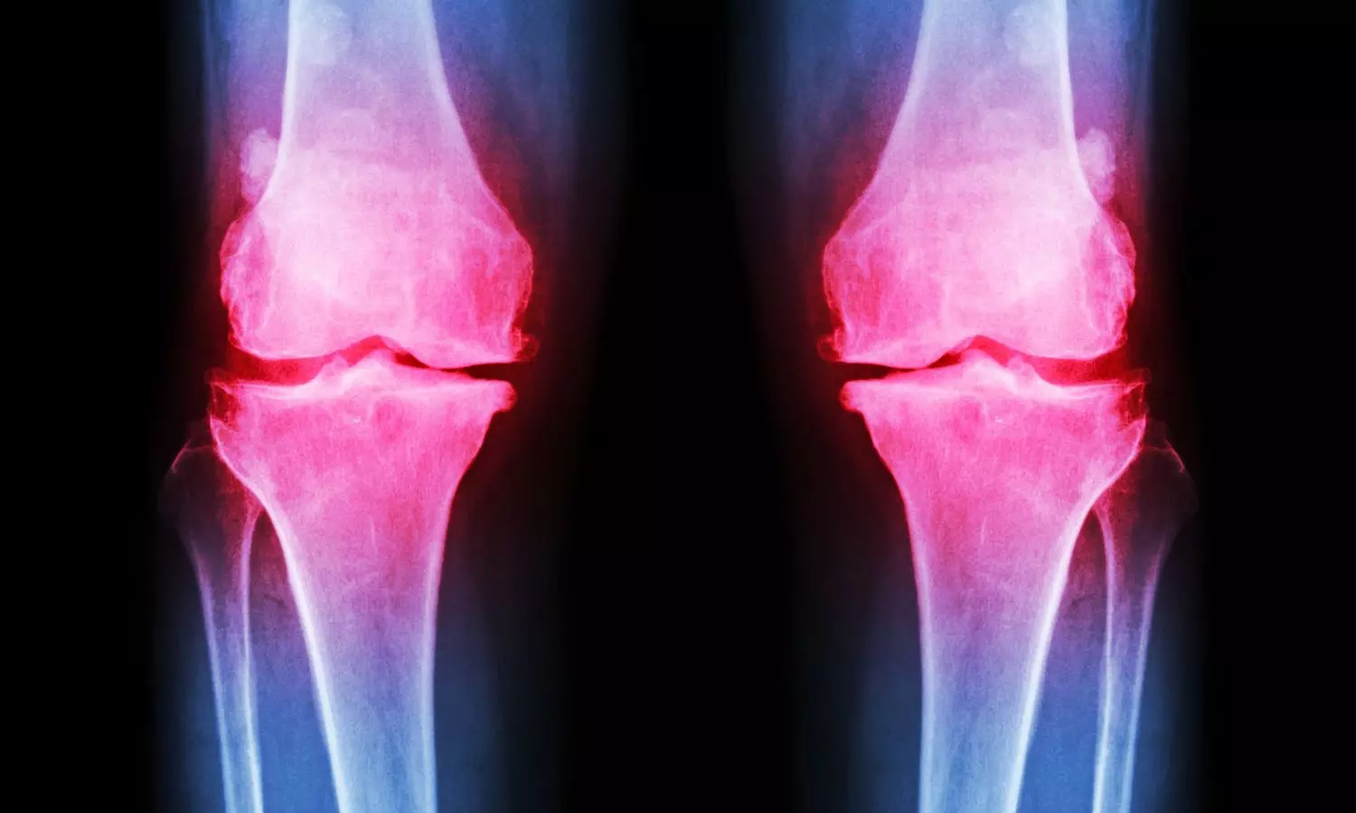 Knee osteoarthritis isnt inevitable - heres what you can do Knee osteoarthritis isnt inevitable - heres what you can do