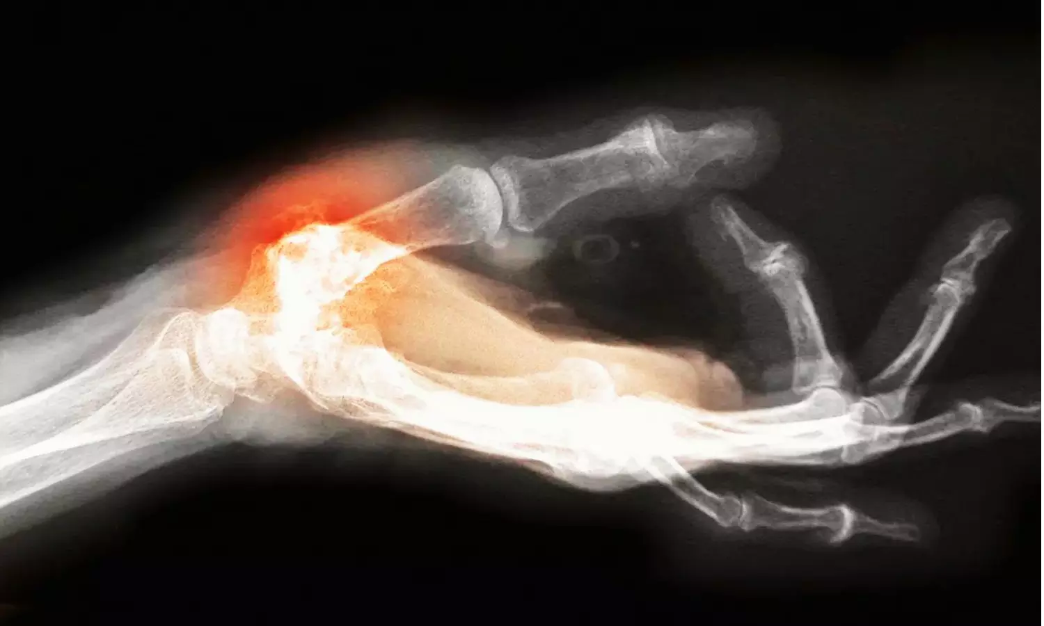 First carpometacarpal and Interphalangeal Synovitis may Predict Hand OA Progression, Suggests Study First carpometacarpal and Interphalangeal Synovitis may Predict Hand OA Progression, Suggests Study