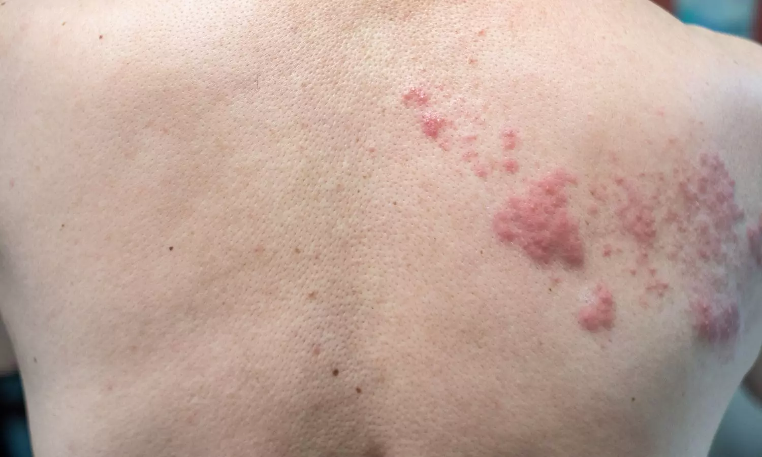 Cavernous Angiomas Identified as a Vascular Manifestation of neurofibromatosis type 1, suggests study Cavernous Angiomas Identified as a Vascular Manifestation of neurofibromatosis type 1, suggests study