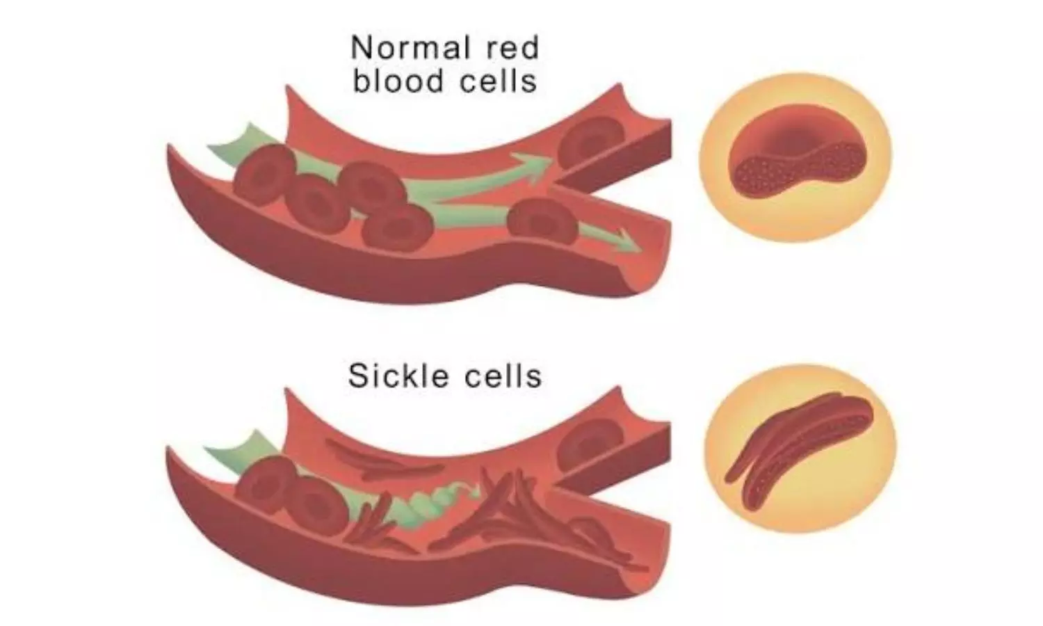Arginine Therapy fails to Shorten Sickle Cell Pain Crises, suggests study Arginine Therapy fails to Shorten Sickle Cell Pain Crises, suggests study