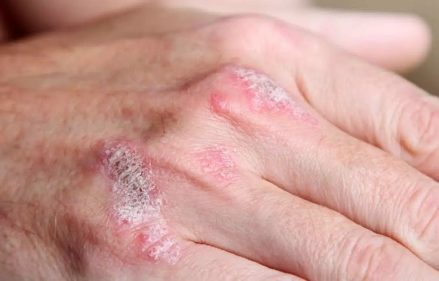 Calcipotriol/betamethasone Cream: Effective and Well-Tolerated Psoriasis Treatment Calcipotriol/betamethasone Cream: Effective and Well-Tolerated Psoriasis Treatment