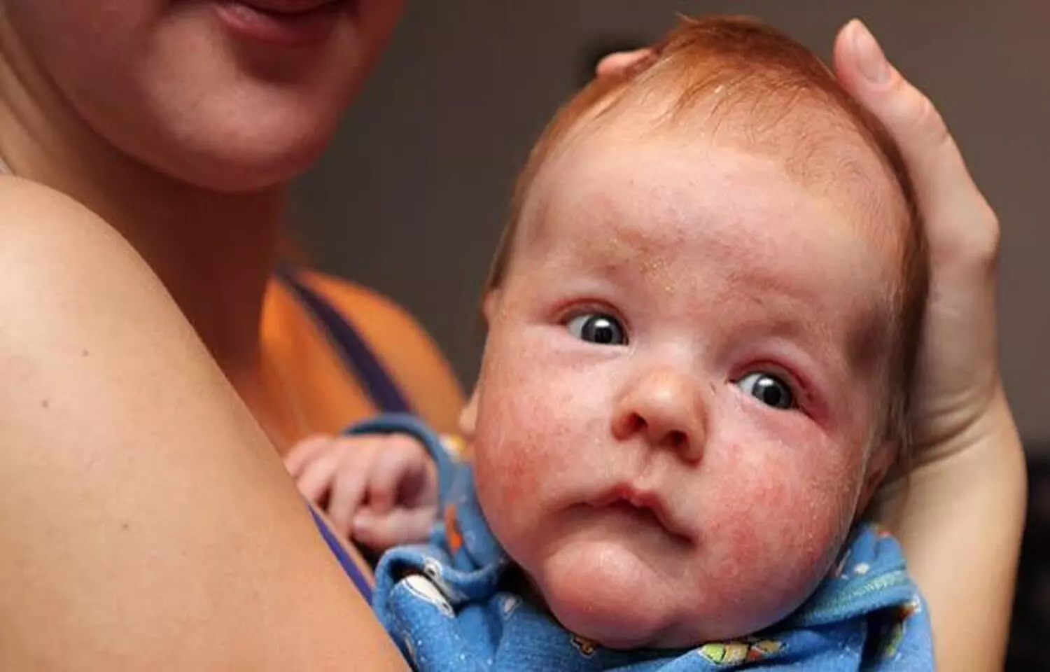 Salivary Biomarkers May Predict Early-Onset Atopic Dermatitis: Study Salivary Biomarkers May Predict Early-Onset Atopic Dermatitis: Study