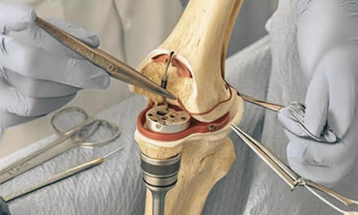 RACER-Knee Trial: Robotic Assistance Improves Precision but Not Patient Outcomes at One Year RACER-Knee Trial: Robotic Assistance Improves Precision but Not Patient Outcomes at One Year