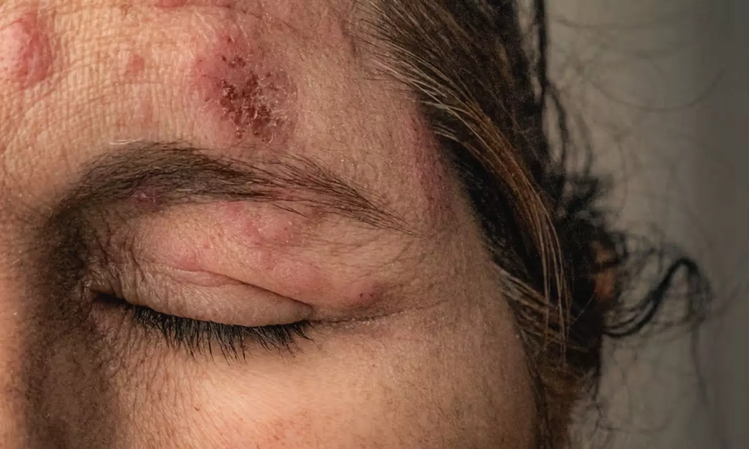 Valacyclovir May Reduce Zoster Eye Complications, suggests study Valacyclovir May Reduce Zoster Eye Complications, suggests study
