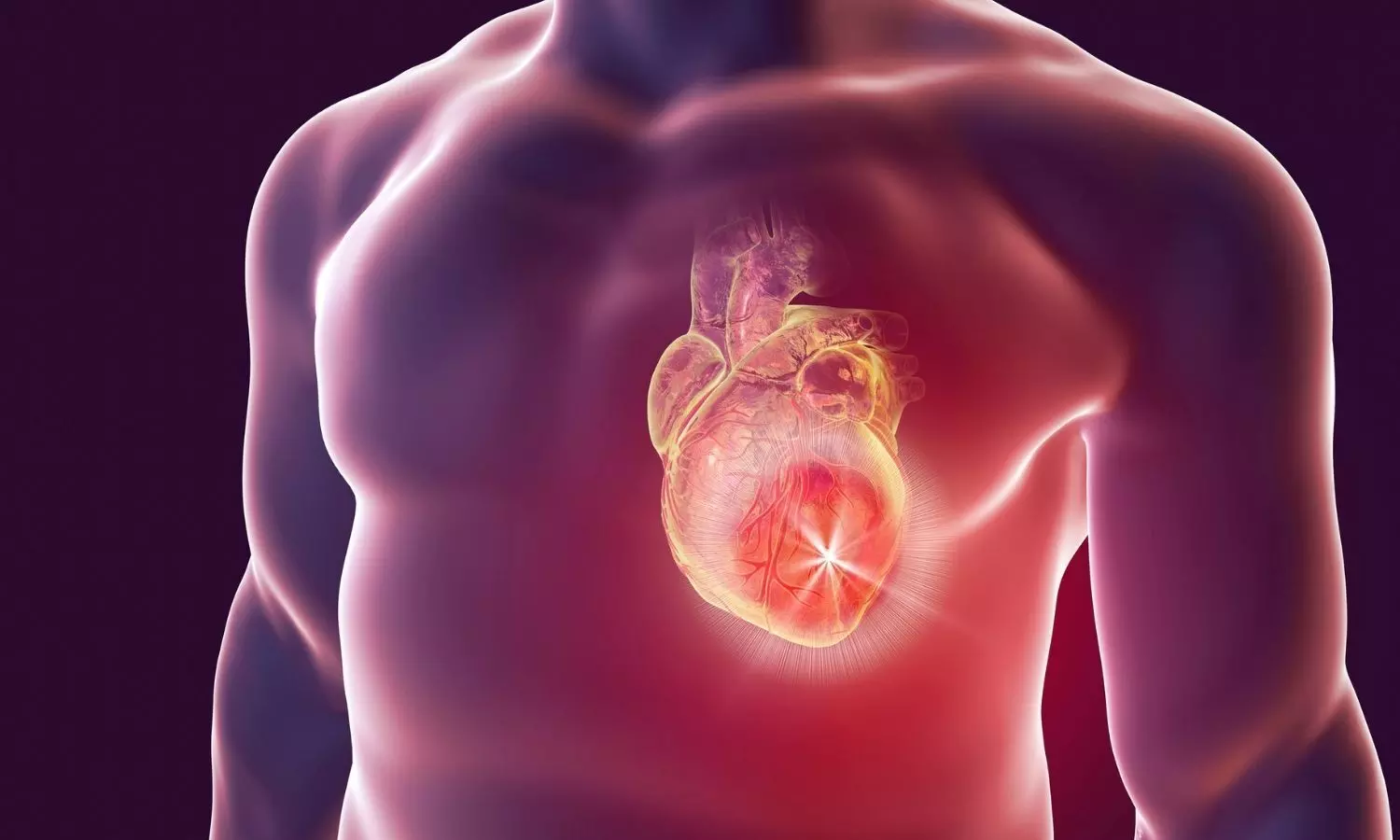 TAVI-First Strategy Noninferior to PCI-First in Severe Aortic Stenosis with CAD, suggests study