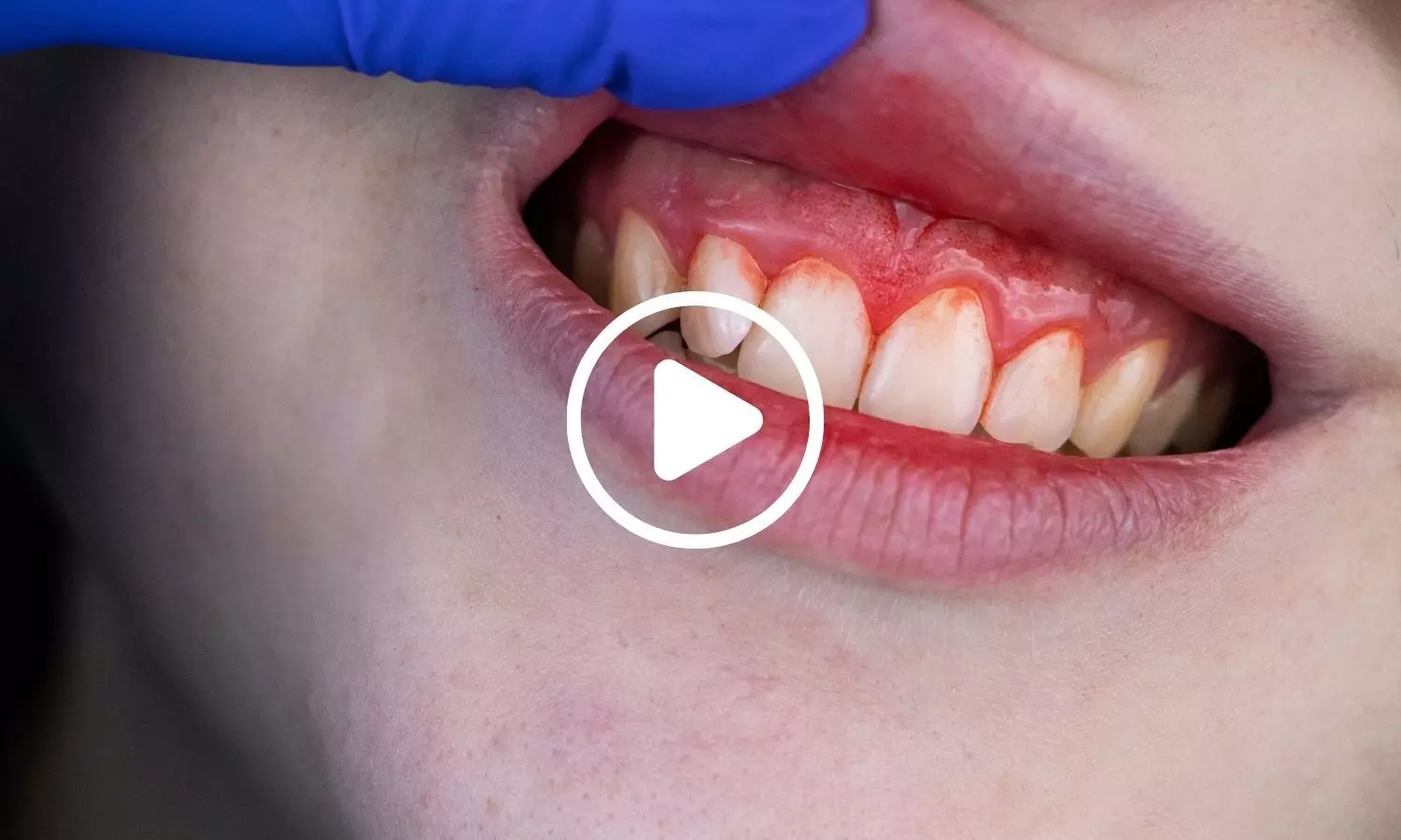 Study Finds Common Supplements Could Rival Antibiotics Against Severe Gum Disease
