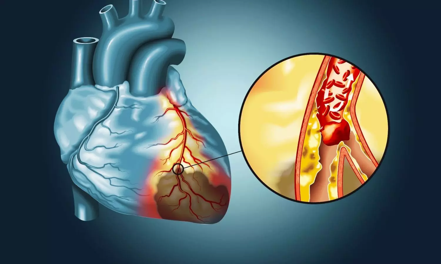 ICIs and VEGFIs Not Linked to Detectable Arterial Inflammation in Patients with Cancer: JAMA ICIs and VEGFIs Not Linked to Detectable Arterial Inflammation in Patients with Cancer: JAMA