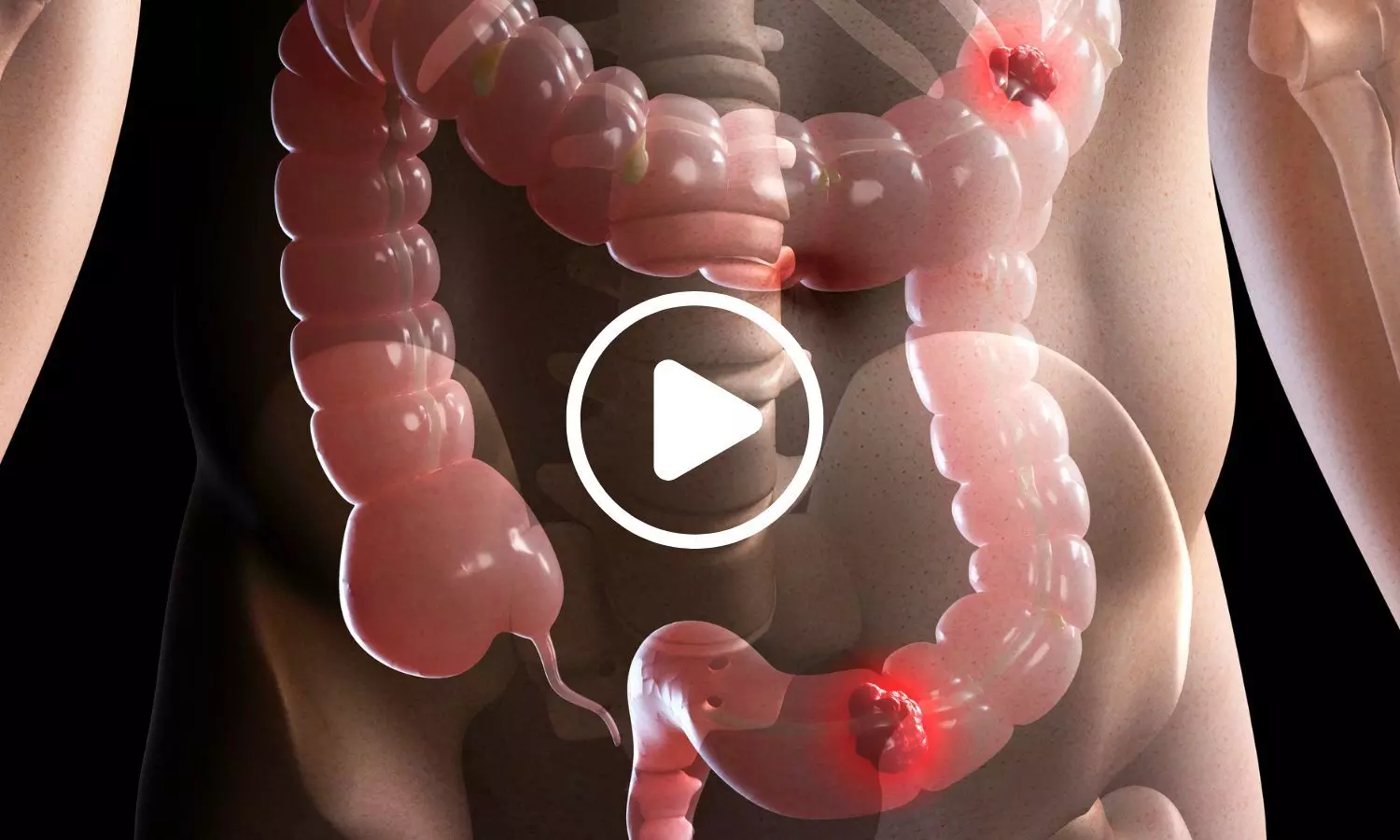 Study Links H. pylori Exposure to One in Five Bowel Cancer Cases