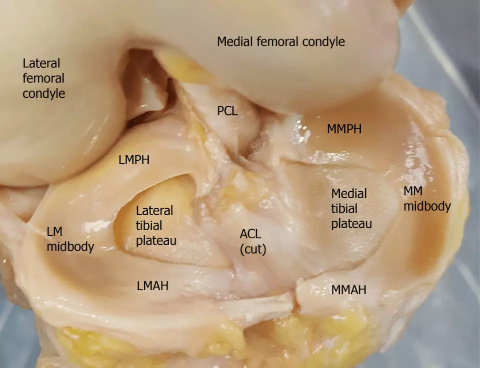 Proteomic Analysis Reveals Distinct Protein Expression in Femoral and Tibial Condyles of Osteoarthritic Knees: Study