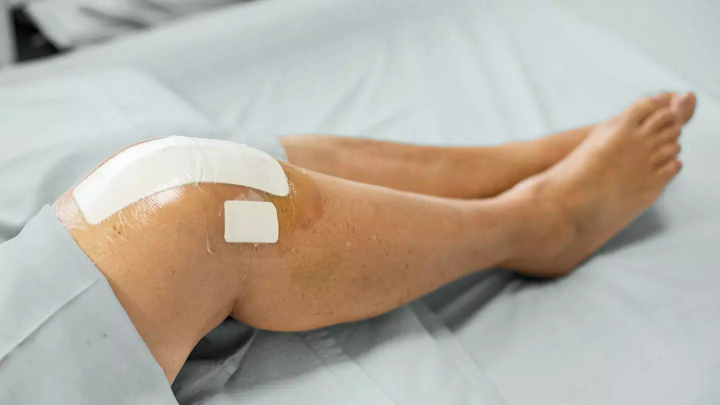 TKA Incisions should avoid Choke zone to minimize risk of postoperative skin ischemia: study TKA Incisions should avoid Choke zone to minimize risk of postoperative skin ischemia: study