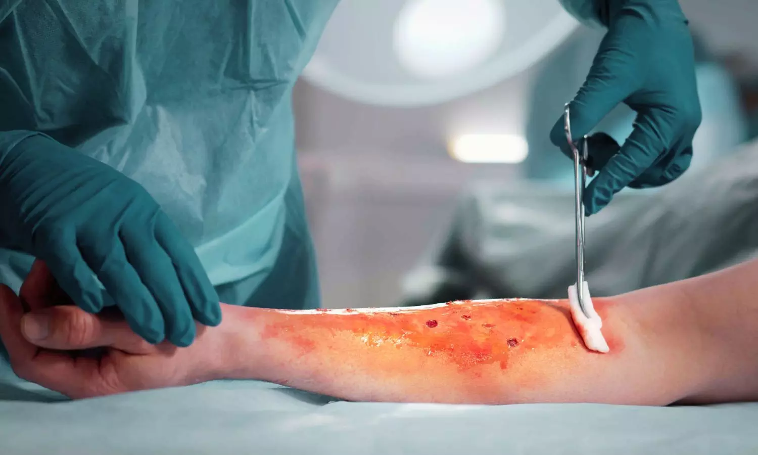 High-Dose IV Vitamin C Fails to Improve Severe Burn Outcomes: JAMA High-Dose IV Vitamin C Fails to Improve Severe Burn Outcomes: JAMA