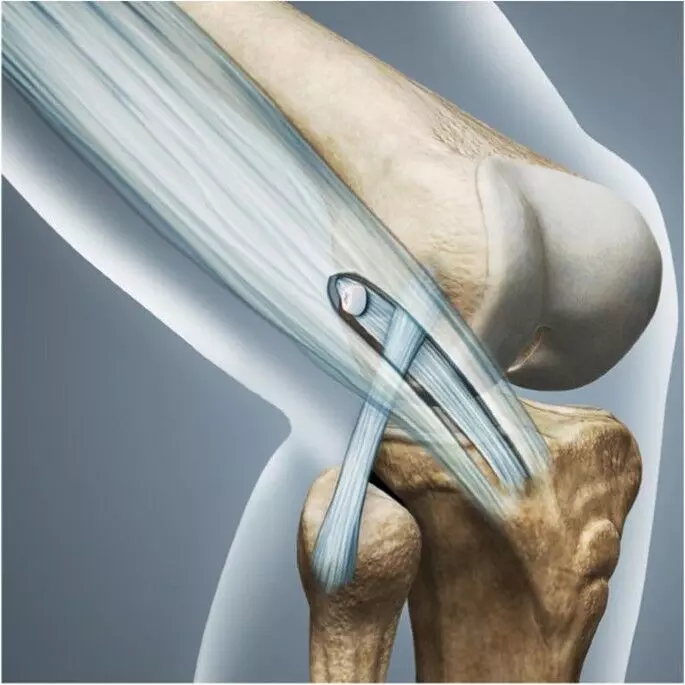 Lateral Extra-articular Procedures May Reduce ACL Reconstruction Revision Risk in Elite Athletes: Study Lateral Extra-articular Procedures May Reduce ACL Reconstruction Revision Risk in Elite Athletes: Study