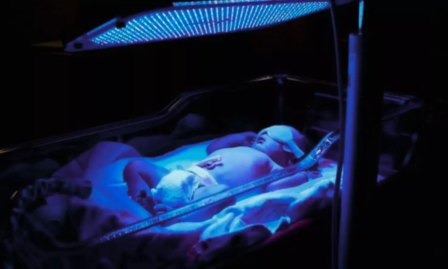Blue Light Phototherapy May Cause Short-Term Skin and Gut Changes in Newborns, Finds Study Blue Light Phototherapy May Cause Short-Term Skin and Gut Changes in Newborns, Finds Study
