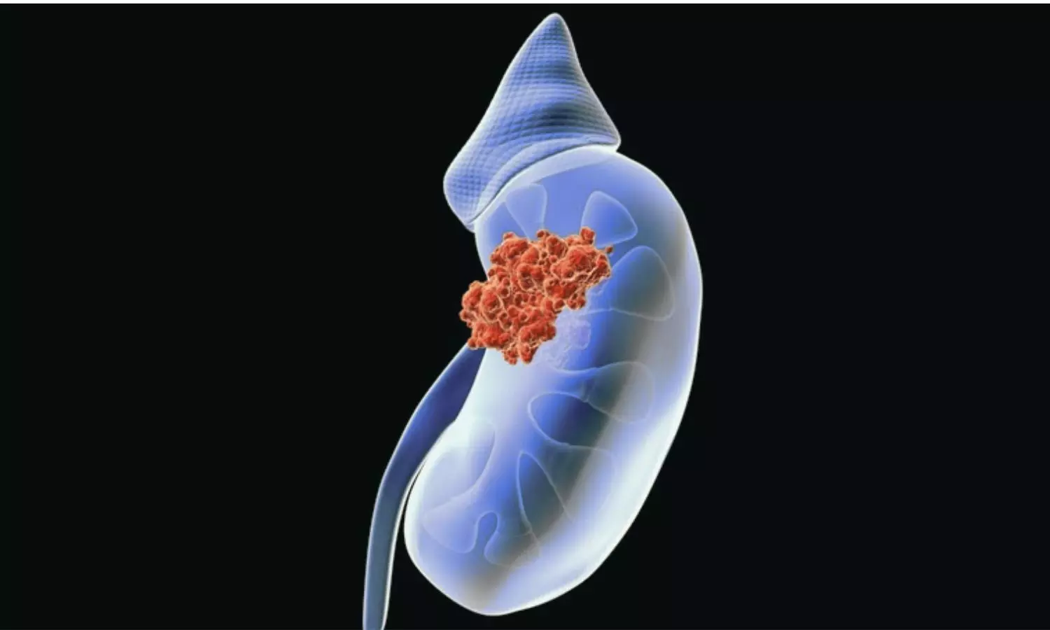 Surgery Within 6 Weeks May Be a Useful Benchmark in Upper Tract Urothelial Cancer: Study Surgery Within 6 Weeks May Be a Useful Benchmark in Upper Tract Urothelial Cancer: Study