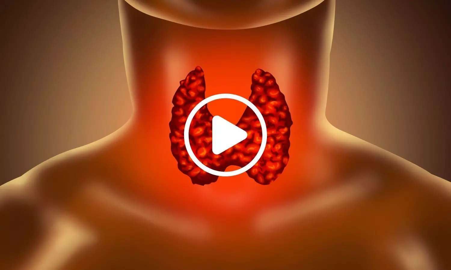 Salt Iodisation Cuts Goitre in Indian Children, but Thyroid Autoimmunity Is Rising: Lancet Study Salt Iodisation Cuts Goitre in Indian Children, but Thyroid Autoimmunity Is Rising: Lancet Study
