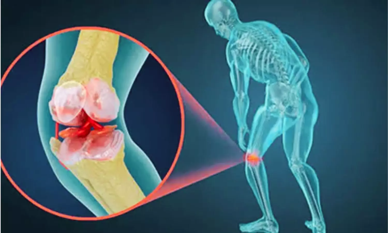 Single Stem Cell Infusion Shows Promise in Advanced Osteoporosis, Suggests Study Single Stem Cell Infusion Shows Promise in Advanced Osteoporosis, Suggests Study