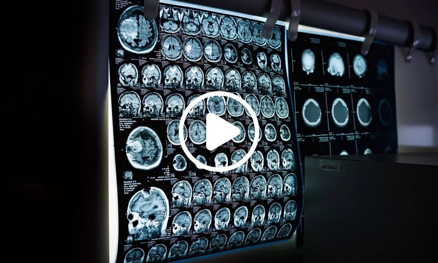 Scientists Find Brain Scan Clues Behind Long COVID Fatigue and Brain Fog