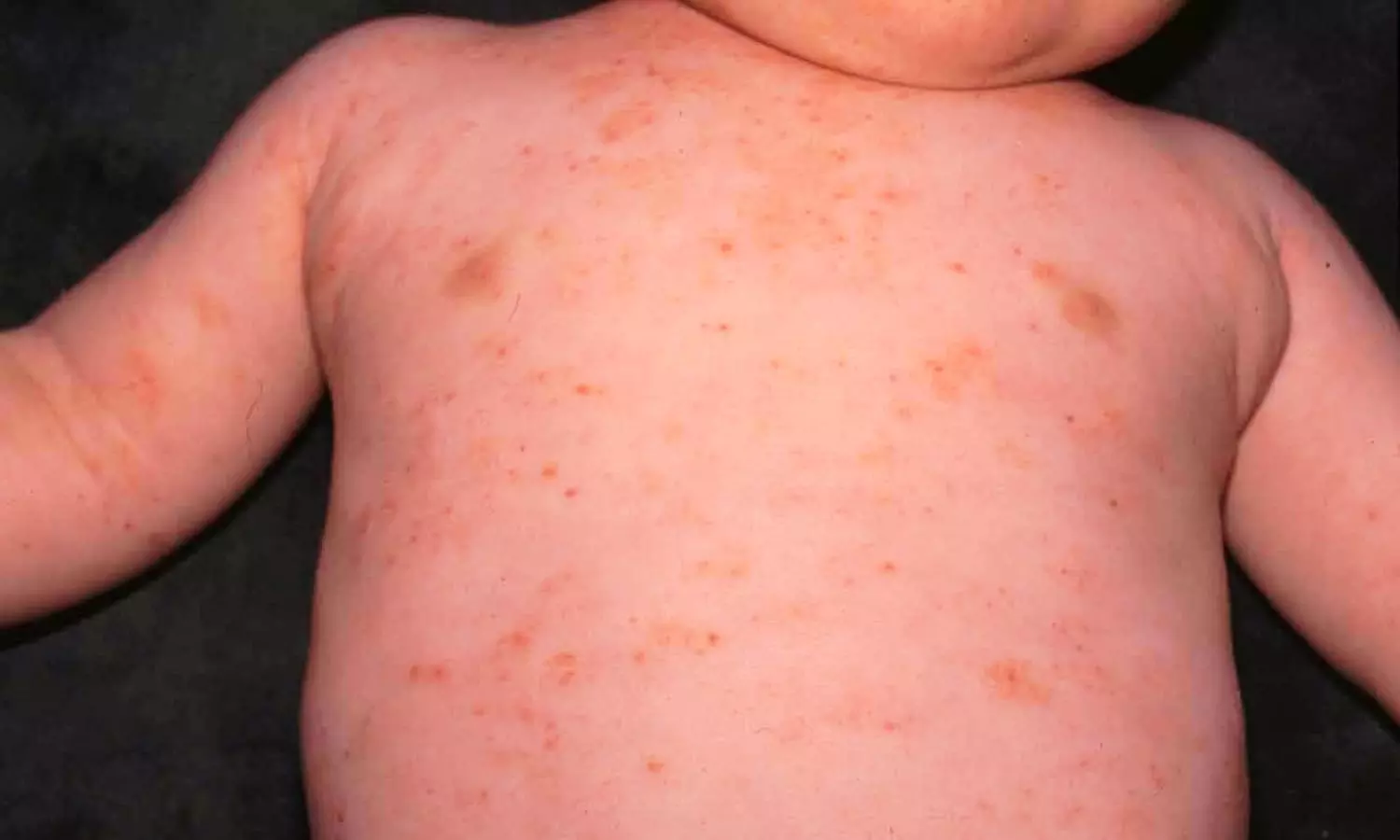 Gene therapy Etu-cel Shows Sustained Clinical Benefit in Wiskott-Aldrich Syndrome: NEJM Gene therapy Etu-cel Shows Sustained Clinical Benefit in Wiskott-Aldrich Syndrome: NEJM