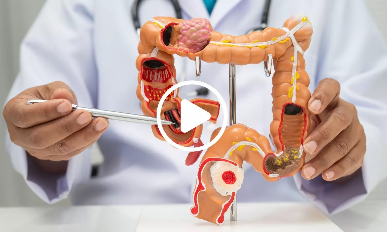 New Engineered Probiotic Approach Reduced Colorectal Tumors by 43 Percent in Mice: Study