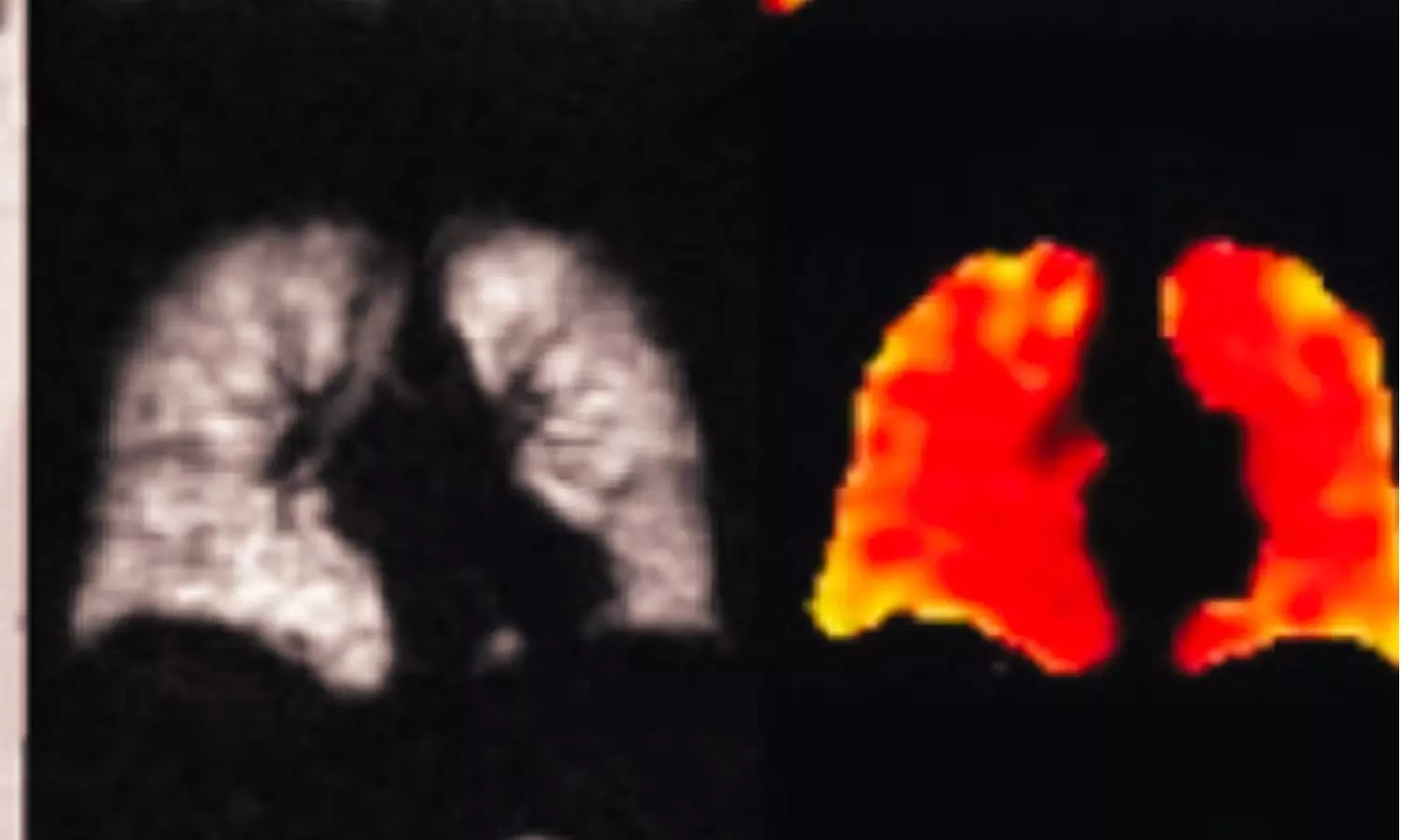 COVID-19 Pneumonia Survivors Show Persistent Lung Abnormalities Radiologically 5 Years Later: Study