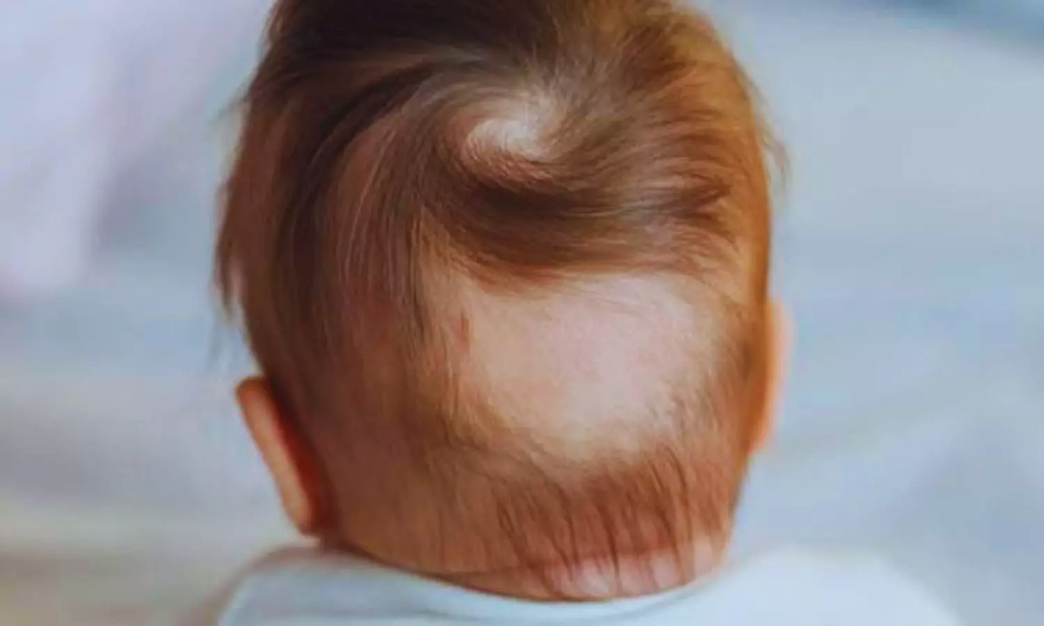 Low-Dose Oral Minoxidil for Pediatric Hair Disorders: International Experts Issue Consensus Recommendations Low-Dose Oral Minoxidil for Pediatric Hair Disorders: International Experts Issue Consensus Recommendations