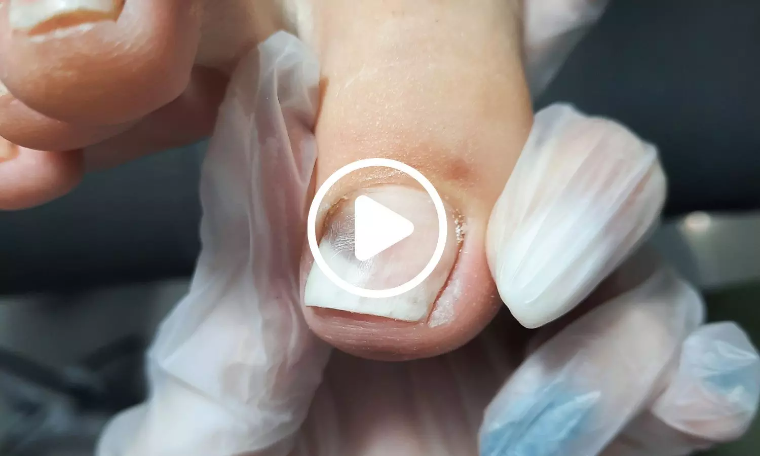 First Controlled Study Links GLP-1 Use to Fourfold Higher Nail Detachment Risk