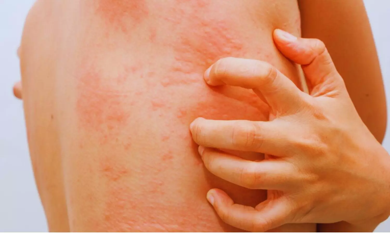 Standard Cold Stimulation Test May Miss 1 in 3 Patients With Cold Urticaria: Study