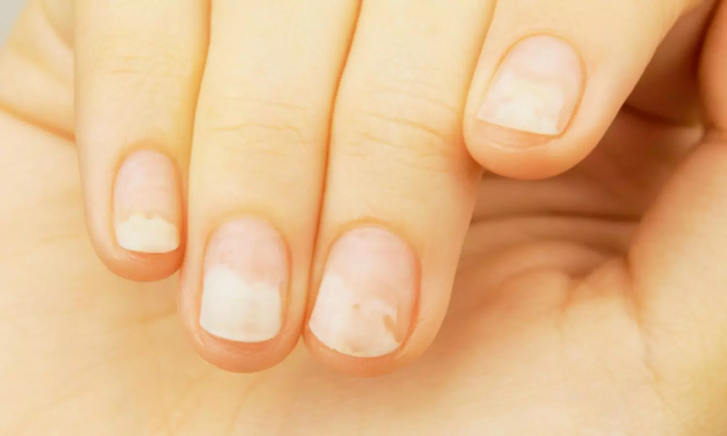GLP-1 Users Show Higher Rates of Nail Detachment and Discolouration: Study