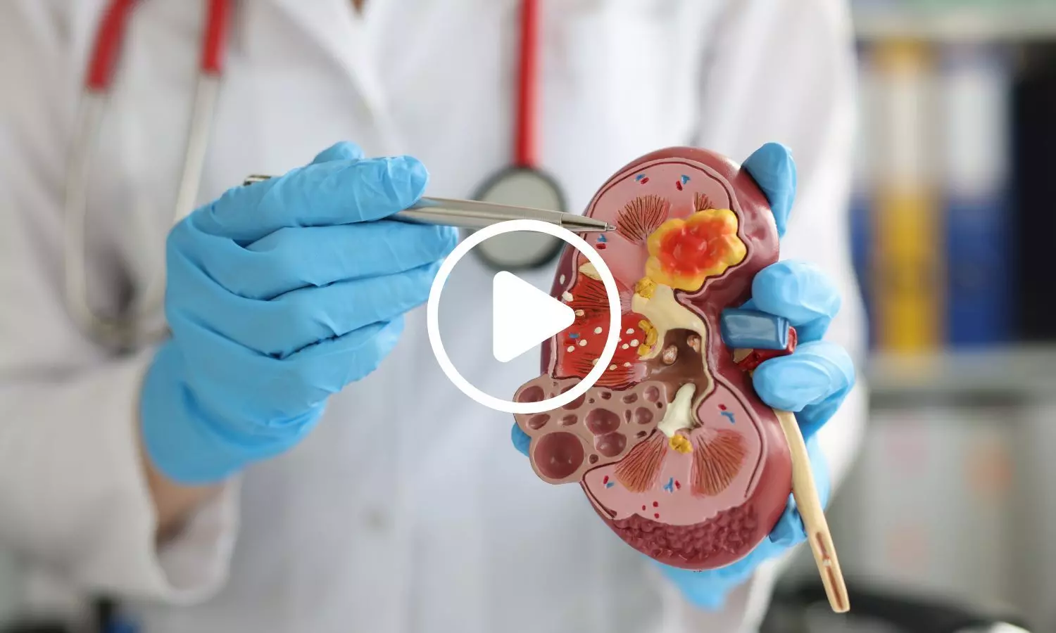 Study Links Longer Sleep Duration to Increased Kidney Disease Risk in Type 2 Diabetes