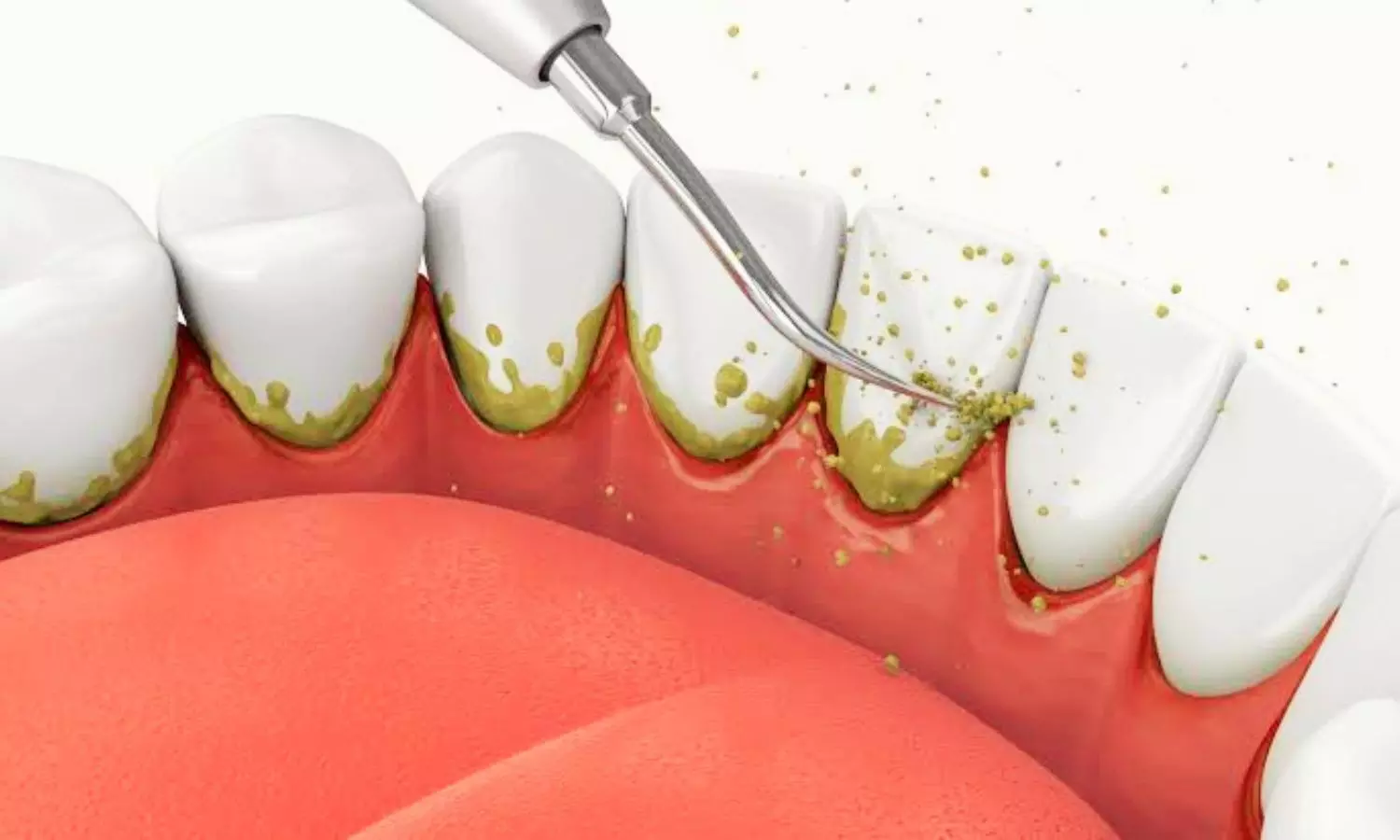 Platelet-Rich Fibrin Plus Minocycline Shows Comparable Short-Term Outcomes to Arestin in Periodontal Treatment: Study Platelet-Rich Fibrin Plus Minocycline Shows Comparable Short-Term Outcomes to Arestin in Periodontal Treatment: Study