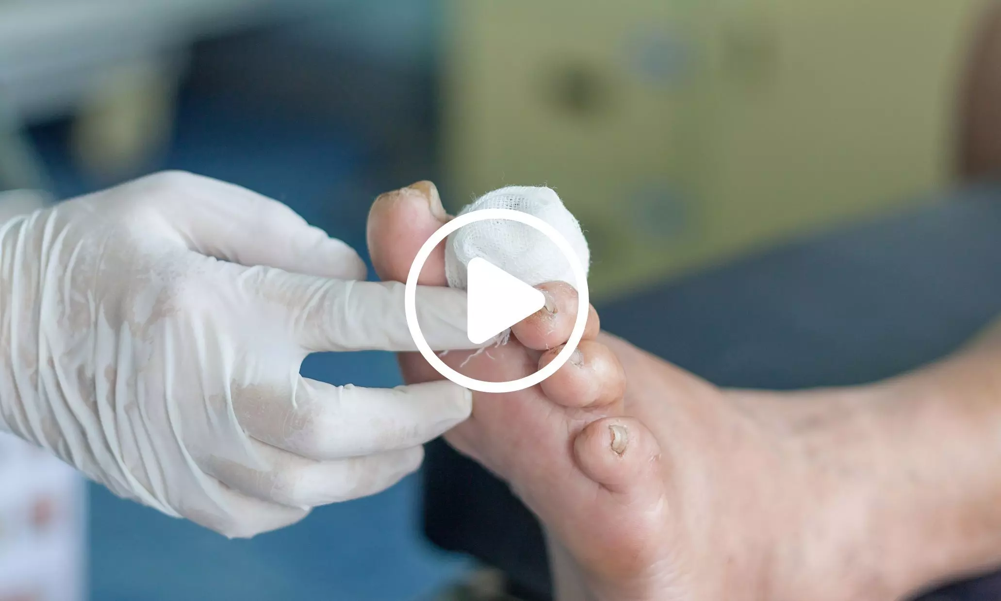 Researchers Uncover Potential Mechanism Behind Poor Healing of Diabetic Wounds Researchers Uncover Potential Mechanism Behind Poor Healing of Diabetic Wounds