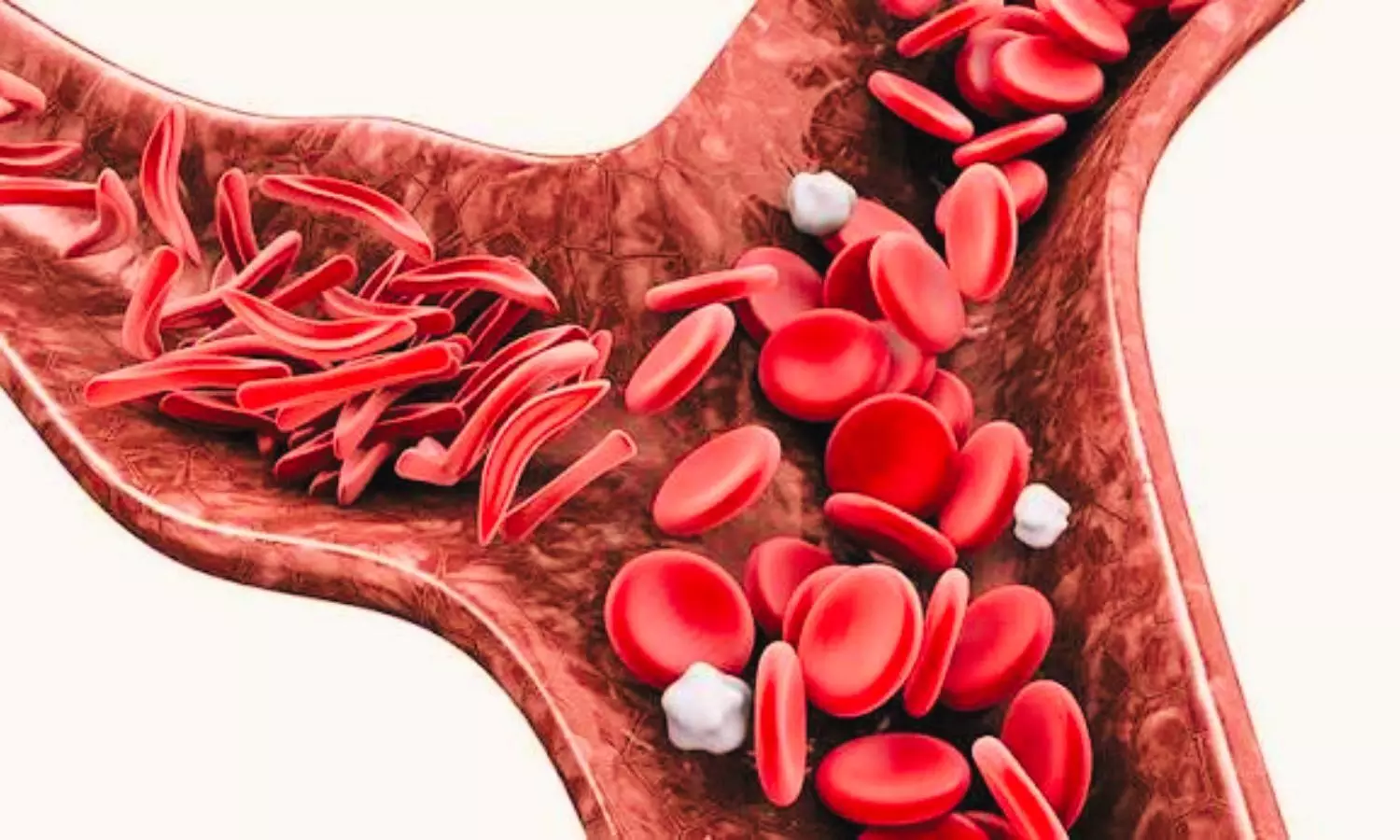 Intravenous Arginine Fails to Shorten Sickle Cell Pain Crises in Children and Young Adults: STArT Trial Finds
