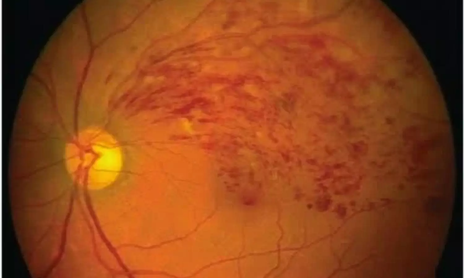 Faricimab Improves Macular Edema and Visual Acuity in Retinal Vein Occlusion: Study Faricimab Improves Macular Edema and Visual Acuity in Retinal Vein Occlusion: Study