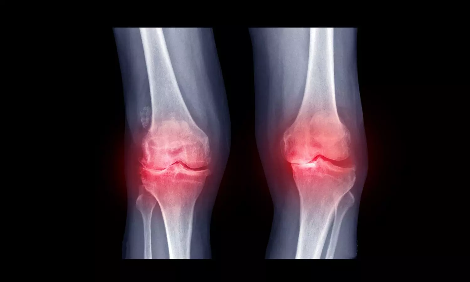 Why painful arthritis can return stronger after cancer treatment? Why painful arthritis can return stronger after cancer treatment?