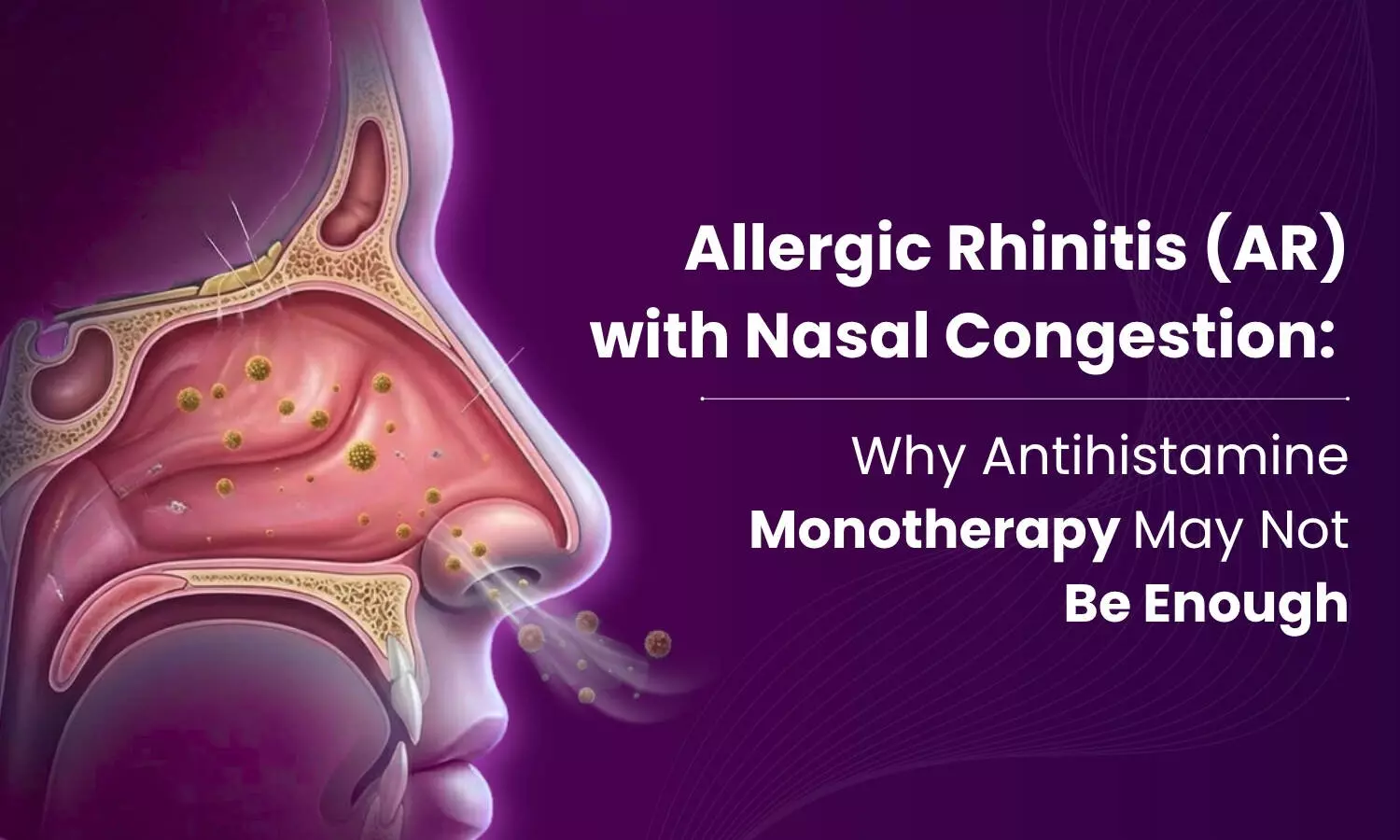 Allergic Rhinitis (AR) with Nasal Congestion: Why Antihistamine Monotherapy May Not Be Enough