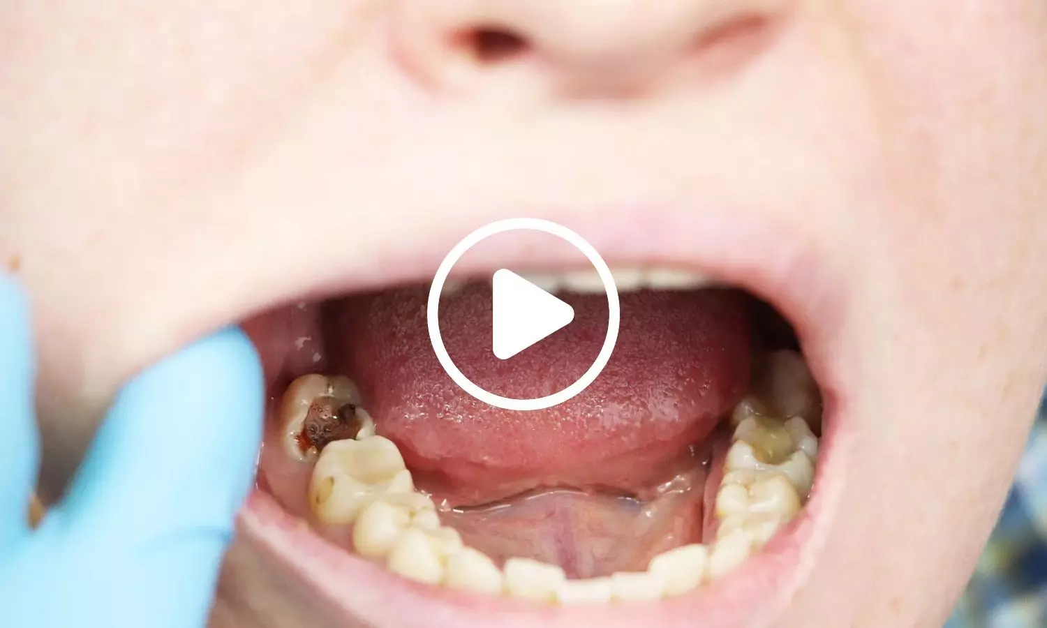 Scientists Discover Non-Invasive Way to Treat Childhood Cavities Without Drilling or Anaesthesia