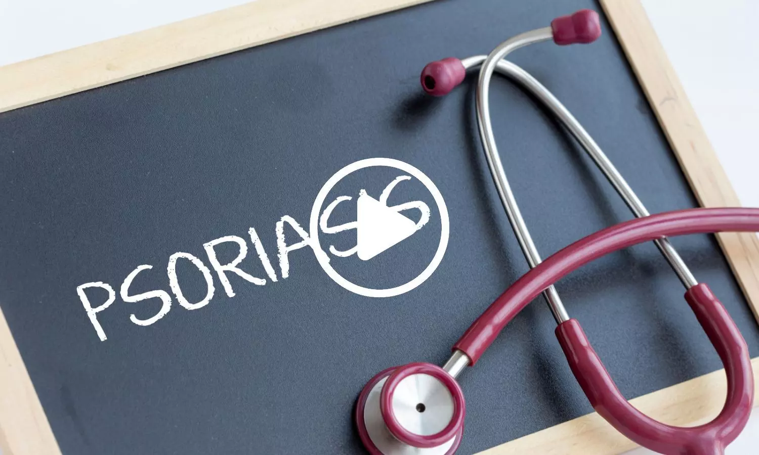 Researchers Uncover Potential New Approach to Psoriasis Treatment Using Nutritional Supplement