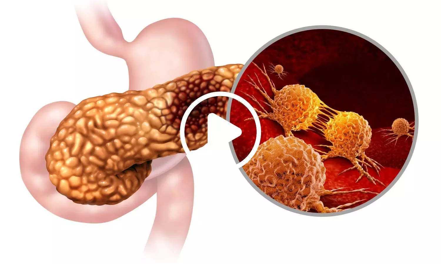 Scientists Develop AI Tool That Spots Early Pancreatic Cancer Signs Missed on Routine CT Scans Scientists Develop AI Tool That Spots Early Pancreatic Cancer Signs Missed on Routine CT Scans