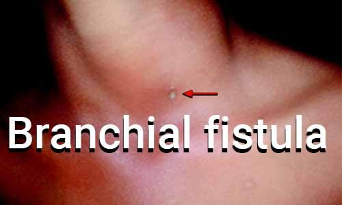 Branchial Fistula- Standard Treatment Guidelines by Government of India