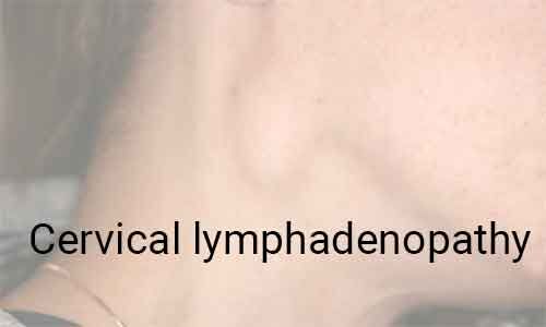 Cervical lymphadenopathy- Standard Treatment Guidelines By Government Of India