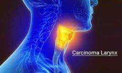 Carcinoma Larynx- Govt of India Standard Treatment Guidelines