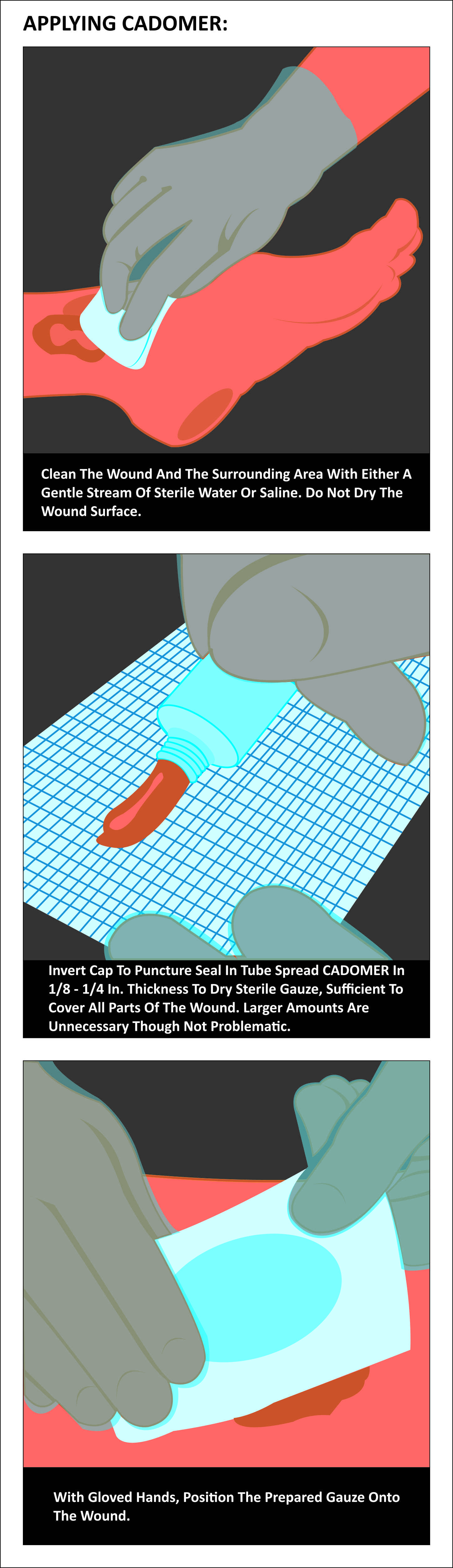 Cadomer (Cadexomer Iodine)