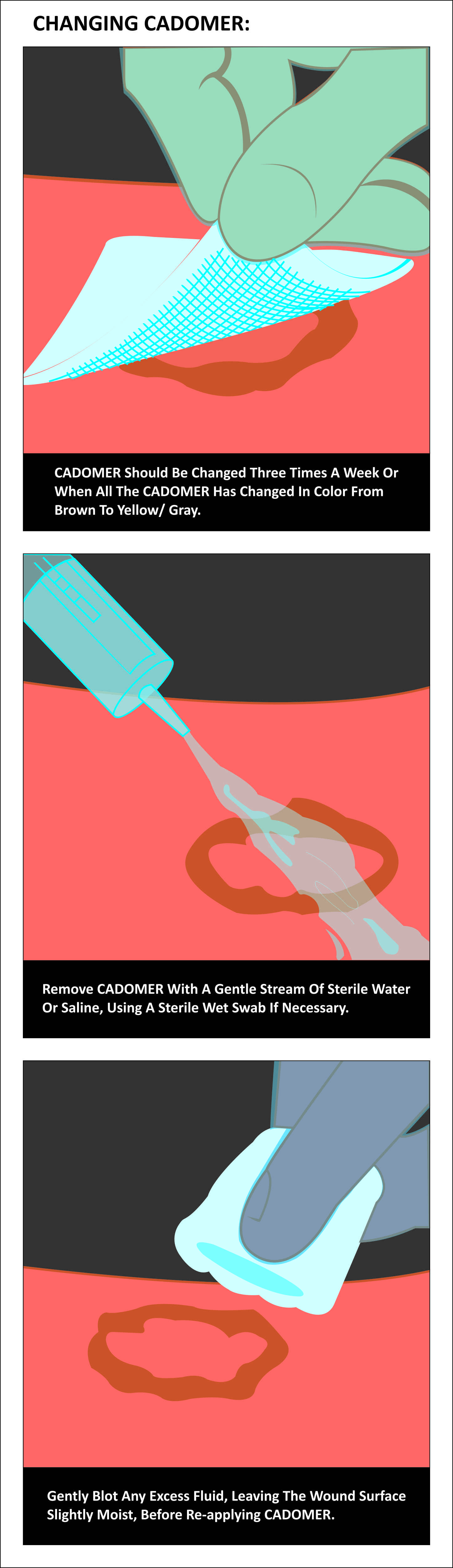 Cadomer (Cadexomer Iodine)