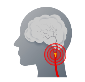 Molnupiravir tablet for patients with Cerebrovascular disease