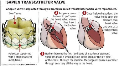 USFDA approves SAPIEN 3 Transcatheter Heart Valve