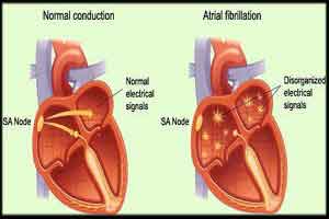 Karnatakas Kasturba Hospital uses a left atrial plug device to prevent risk of strokes