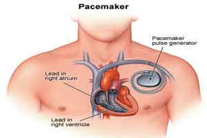 Patients With pacemakers should be careful with smartphones: USFDA