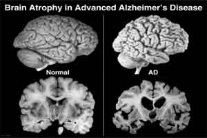 Alzheimers-Related Degeneration Starts Much Before Symptoms: Study