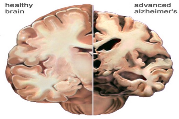 Indian origin UK boy achieves a breakthrough in tests for an early detection of Alzheimers